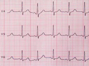 Heart Rate Variability
